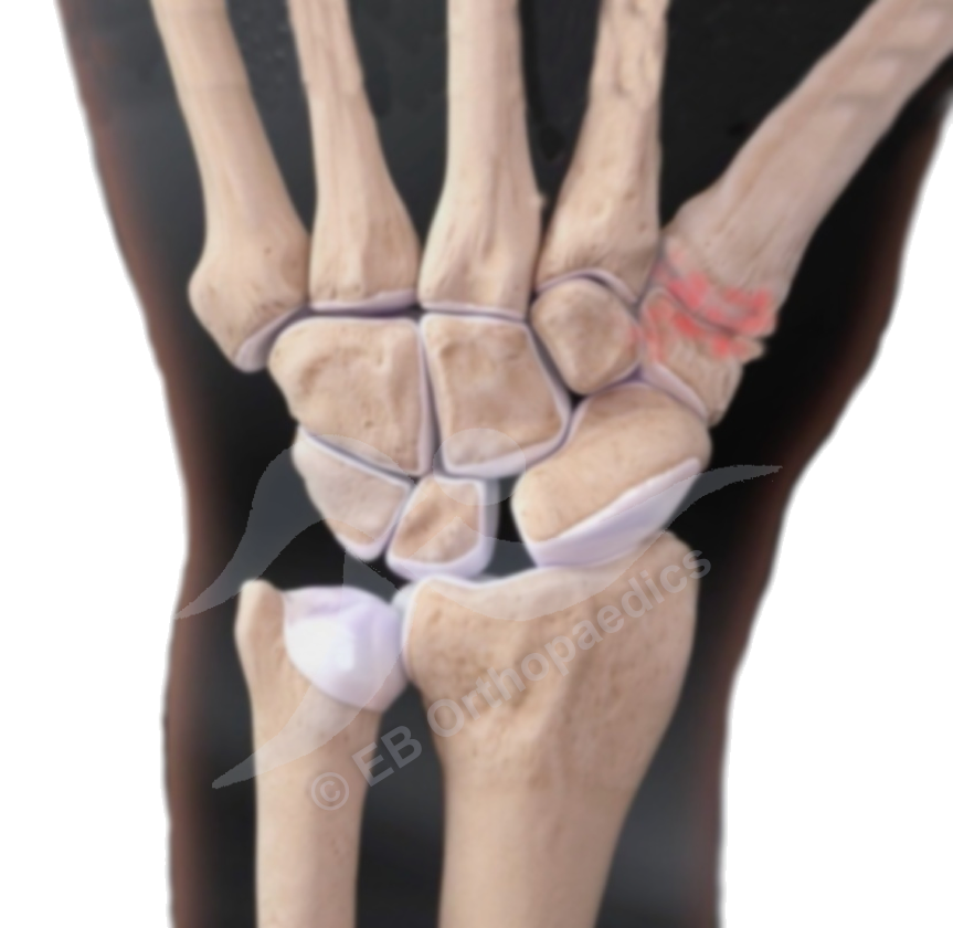 CMCJ arthritis